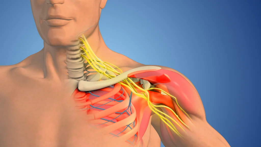 FAQ: Thoracic Outlet Syndrome