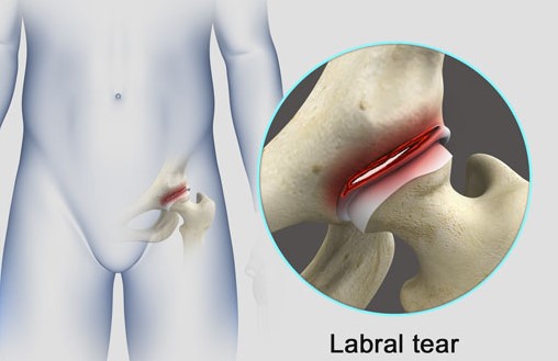 FAQ: Labral tears of the hip