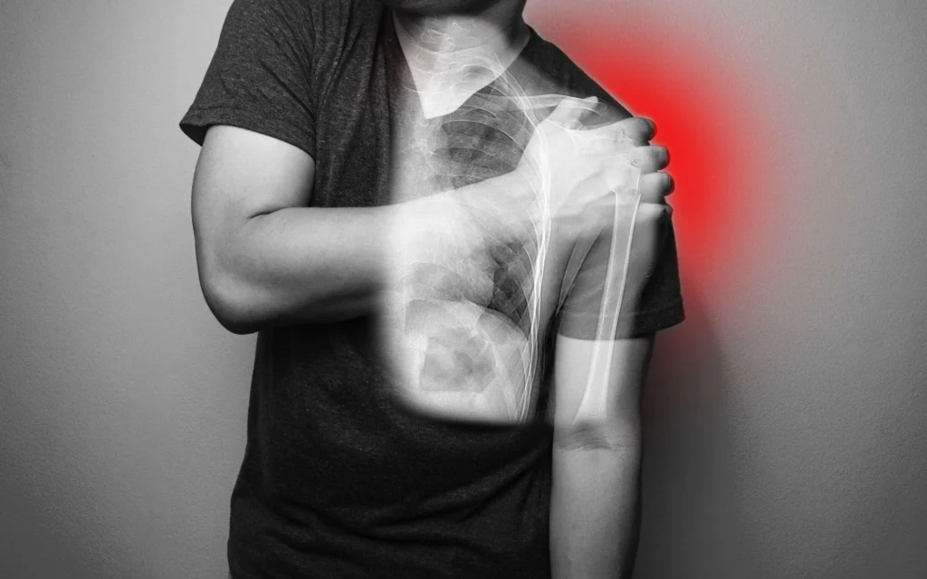 FAQs: Shoulder Dislocations